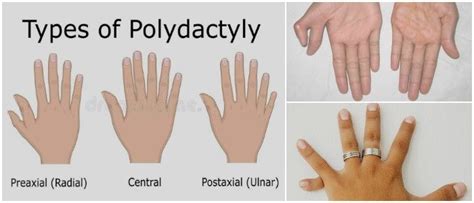 Polidactilia Definición Síntomas Causas Tipos y Tratamiento