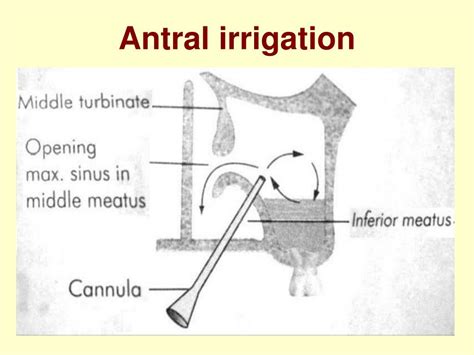 Ppt Surgical Treatment Of Sinusitis Powerpoint Presentation Id226352