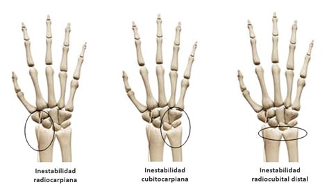 Esguince de muñeca qué es síntomas y tratamiento