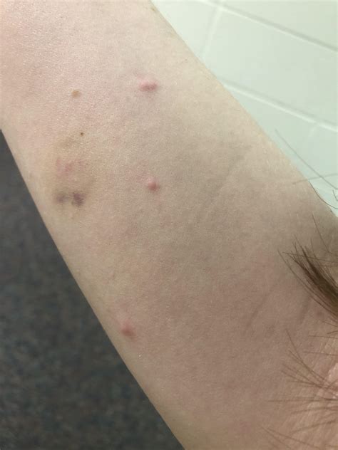 Do these 3 raised bumps look like bed bug bites? The bruise is ...