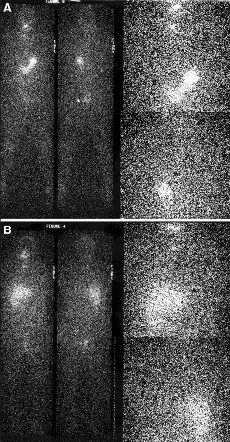 A Whole Body Scan Following 1 Mci 123 I Demonstrates Download