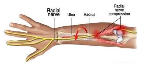 Radial Nerve Entrapment —Physical TheraPT | Comprehensive Athletic Recovery