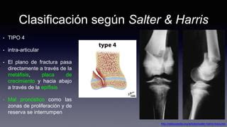 Fracturas de Salter & Harris | PPTX