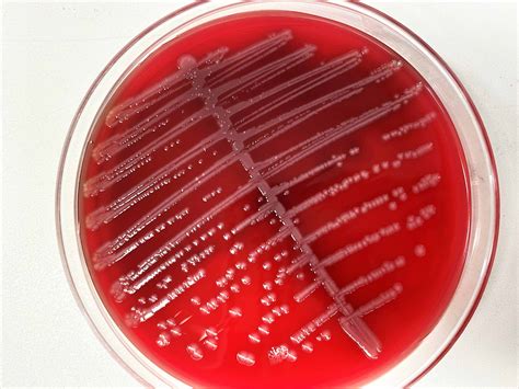 Pathology Outlines Escherichia Coli