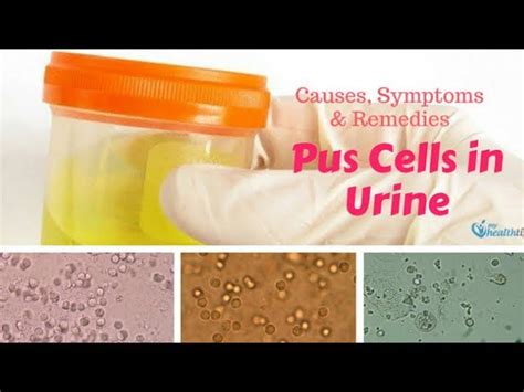 Pus Cells In Urine Normal Range Hpf 55 Off