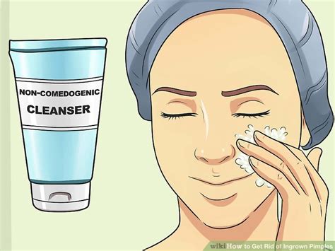 3 Ways to Get Rid of Ingrown Pimples - wikiHow