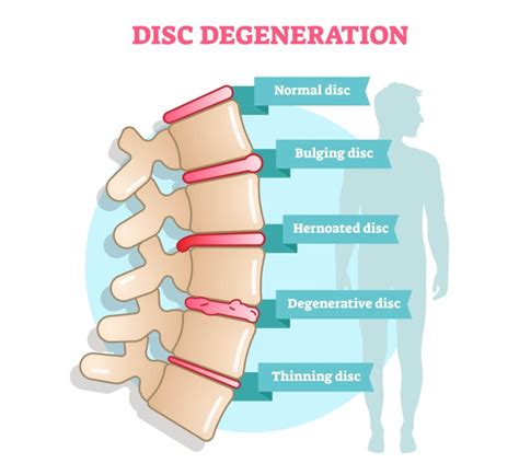 The 3 Stages Of Degenerative Disc Disease | New Jersey | Comprehensive Spine Care