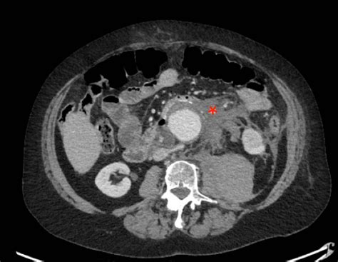 Ruptured Stable AAA CT Transverse 1, Annoated. JETem 2020 - JETem