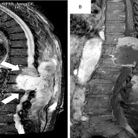 Post Operative Mri Of The Thoracic Spine A B Post Operative Mri Of Download Scientific