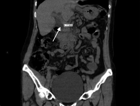 Image Diagnosis Worm Induced Biliary Obstruction The Permanente Journal