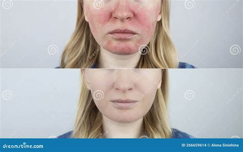 Rosacea Face The Girl Suffers From Redness On Her Cheeks Couperosis Of The Skin Redness And