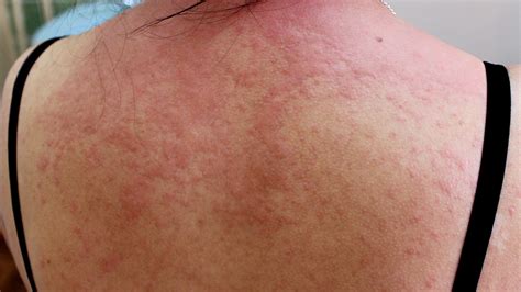 Can You Spread Hives To Other Parts Of Your Body At Jessica Coulson Blog