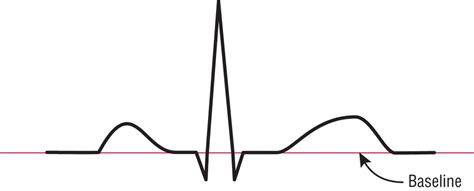 Baseline ECG basics Diagram | Quizlet