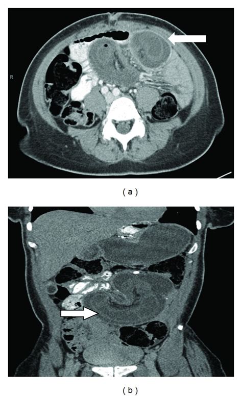 A Axial View Of The Ct Scan Showing Intussusception With Fat And