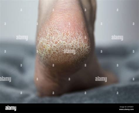 Dry Skin With Cracks On The Heel Of The Foot In A Person Close Up