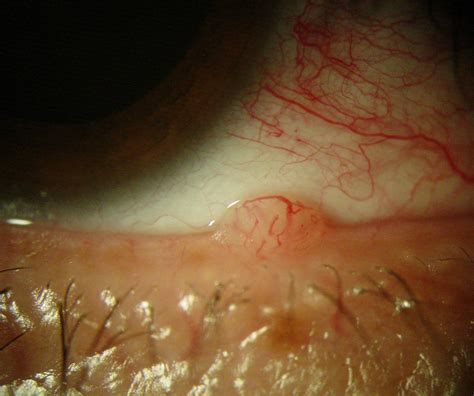 Papiloma Palpebral Compendio De Im Genes De Oftalmolog A