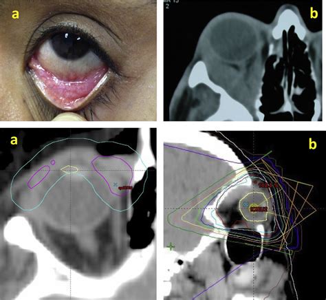 Marginal Zone Lymphoma Of The Orbit A Conjunctival Disease With Download Scientific Diagram