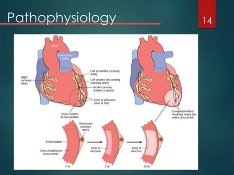 Acute Myocardial Infarction