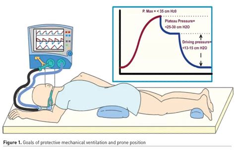 Practical Strategies In Mechanical Ventilation For Patients With Acute