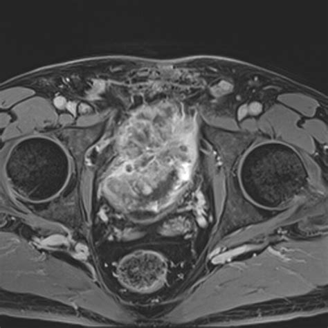 Pelvic Mri T1 Weighted Axial Image Showing Anterior Extrusion Of The