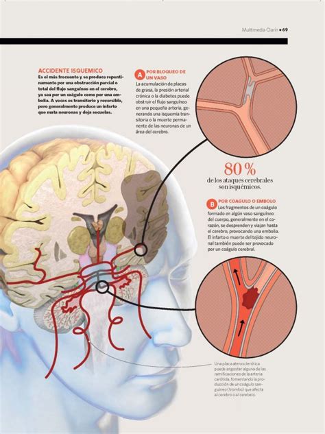 Ataque Cerebral Fleni