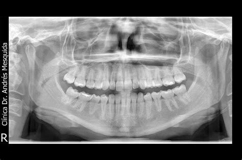 Ortopantomografía digital dentalmesquida