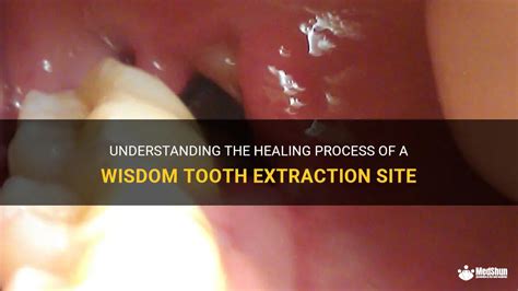 Understanding The Healing Process Of A Wisdom Tooth Extraction Site