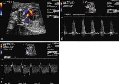 Pulmonary Atresia With Intact Ventricular Septum Radiology Key