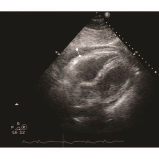 ECG And Echocardiography At Admission A Twelve Lead ECG During