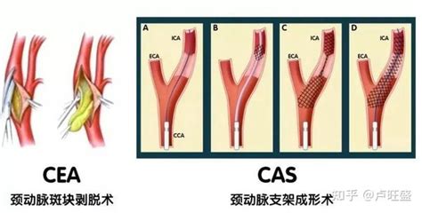 颈动脉狭窄手术：预防卒中的重要环节 知乎