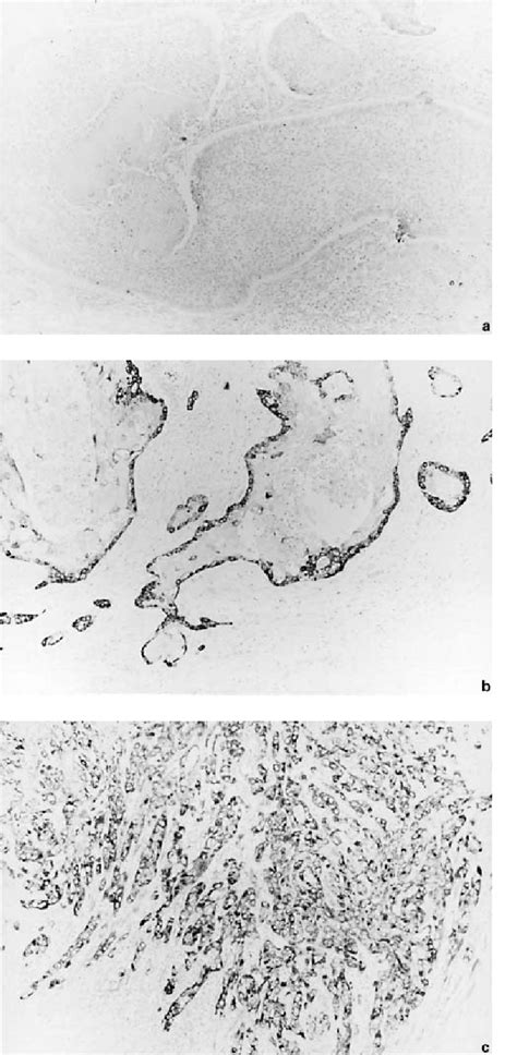 Table 1 From Correlation Between Laminin 5 γ2 Chain Expression And