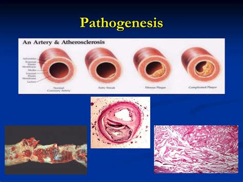 Ppt Atherosclerosis A Surgical Look Powerpoint Presentation Free Download Id 2051016