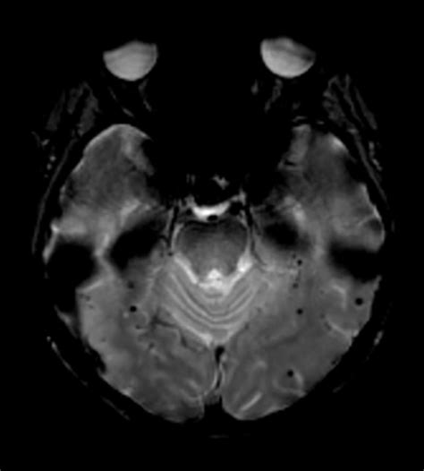 Amyloid Related Imaging Abnormalities An Update Ajr