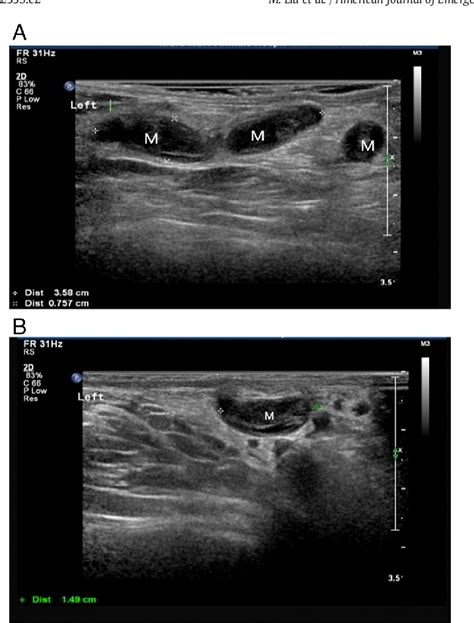 Figure 1 From Ultrasonography Assessment Of Spermatic Vein Thrombosis