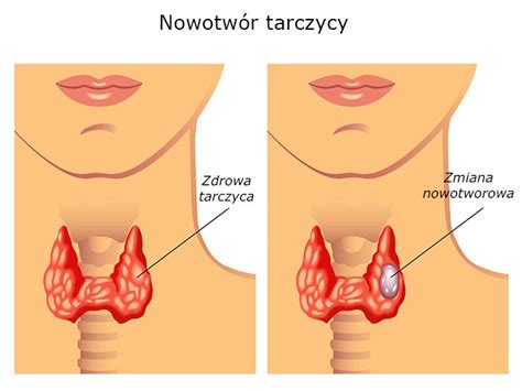 Objawy nowotworów tarczycy ALFA LEK