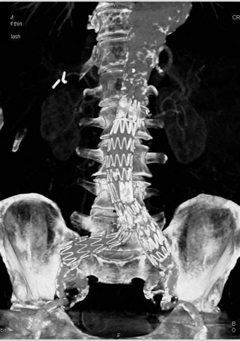 Aortic Valve Calcification And Endovascular Stents In Abdominal Aorta