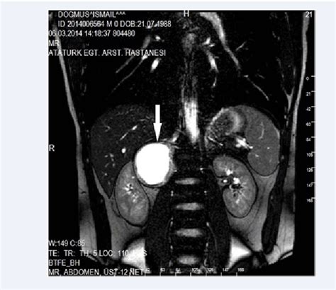 Figure From Retroperitoneal Ancient Schwannoma A Rare Case Report