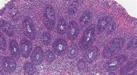 Lymphocytic colitis | Atlas of Pathology