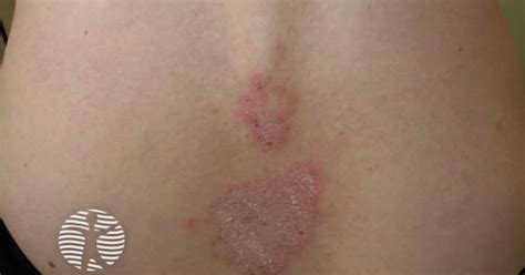 DermNet Chronic Plaque Psoriasis Image