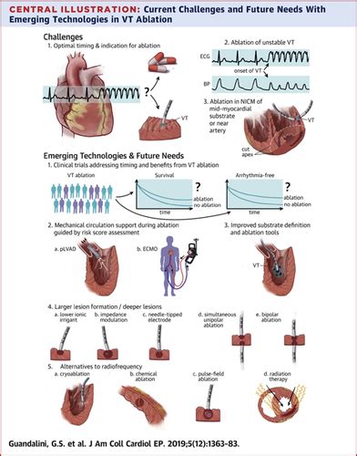 Ventricular Tachycardia Ablation Past Present And Future Perspectives Jacc Clinical