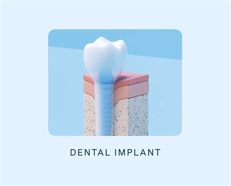 Dental Bridges Vs Implants Choosing The Best Solution Aspen Dental