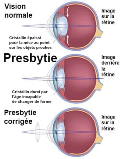 Les Lentilles Multifocales Opération Myopie Presbytie Chirurgie