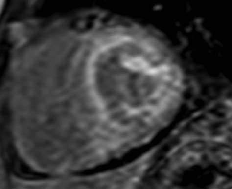 Cardiac MRI in this Era - Indian Journal of Cardiovascular Disease in Women