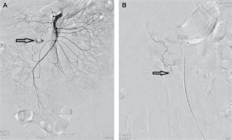 Figure 2 From Superselective Arterial Embolization Of The Superior