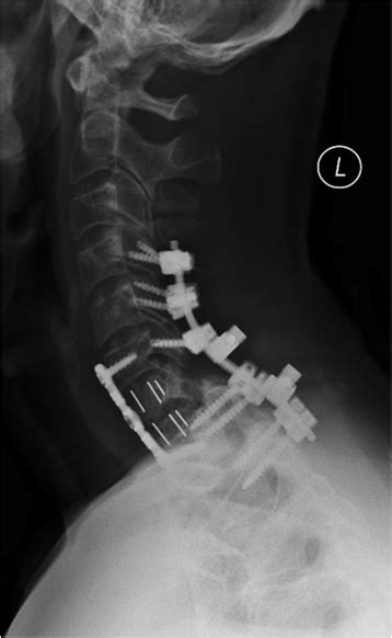 Lateral radiograph of the cervical spine after posterior C4-T1 fusion ...