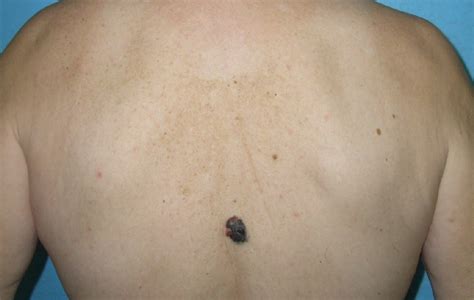 Nodular Malignant Melanoma