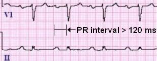 PR Interval on a 12-lead ECG Tracing | LearntheHeart.com