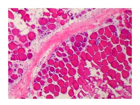 Pathology Outlines Dermatomyositis