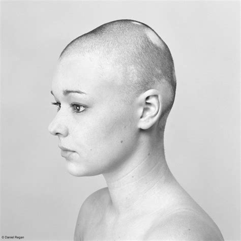 Powerful Photos Of People With Alopecia Prove Bald Is Beautiful