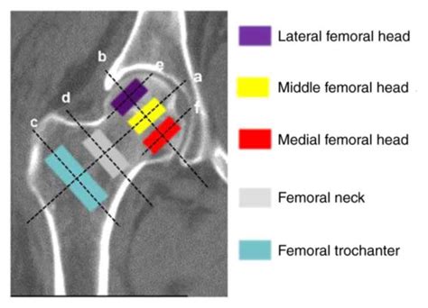 Proximal Femur Lag Screw Placement Based On Bone Mineral Density